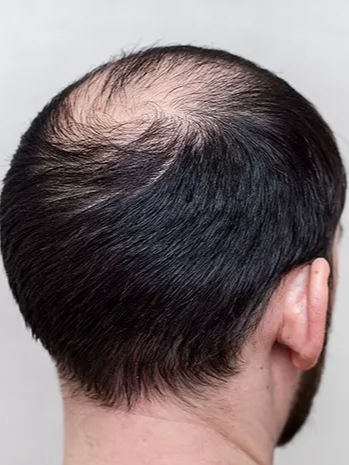 Rambut Tipis
